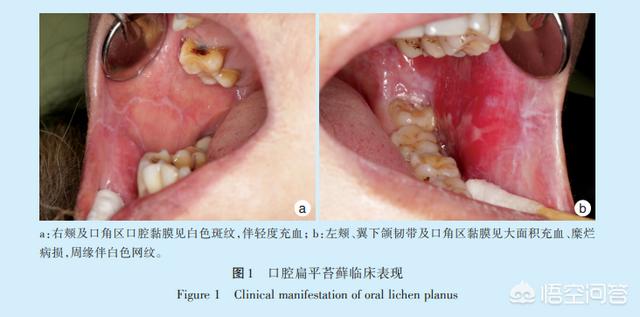 口腔扁平苔藓有什么危害