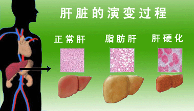 中度脂肪肝的人体检后要注意什么