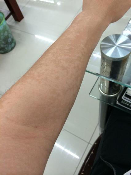 花斑癣是什么为什么夏季易发病