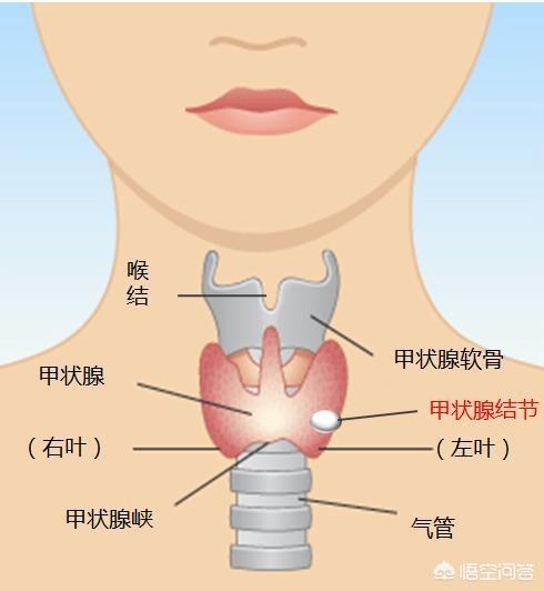 扁桃体结石和甲状腺结节是同一种东西吗有何依据