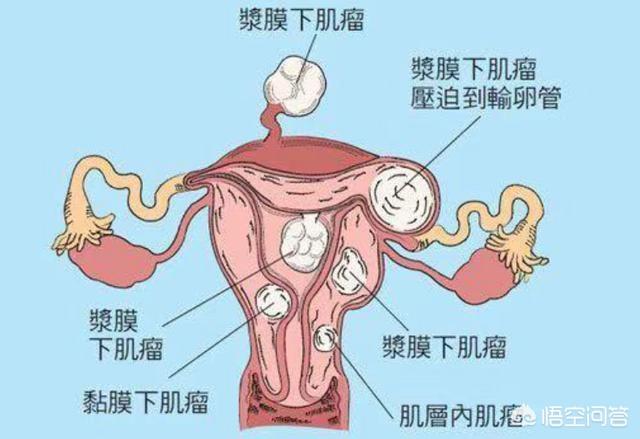 子宫肌瘤很常见如何有效预防子宫肌瘤