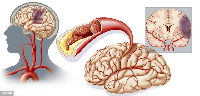 脑血栓和脑梗塞的区别是什么？