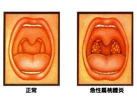 两岁宝宝总是扁桃体化脓发炎该如何调理