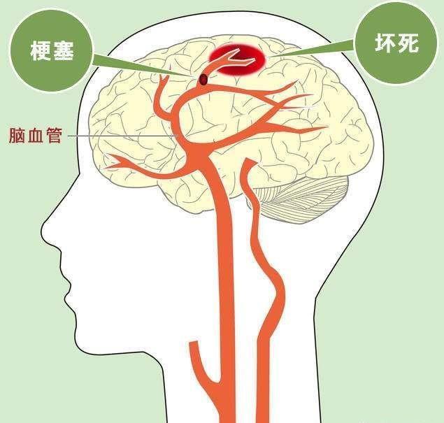 脑出血和脑血栓有区别吗