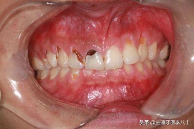 牙疼和牙缝疙瘩同时发生是啥原因造成与每顿饭都吃醋有关系吗