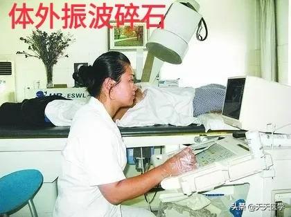 全网谁有治疗肾结石排石化石的方法