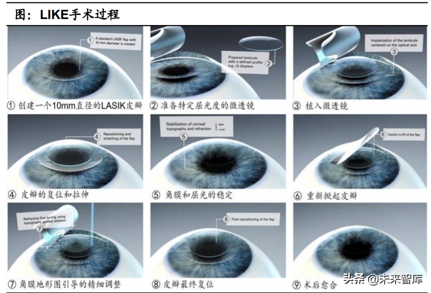 眼科產業鏈深度報告：創新驅動，服務為王