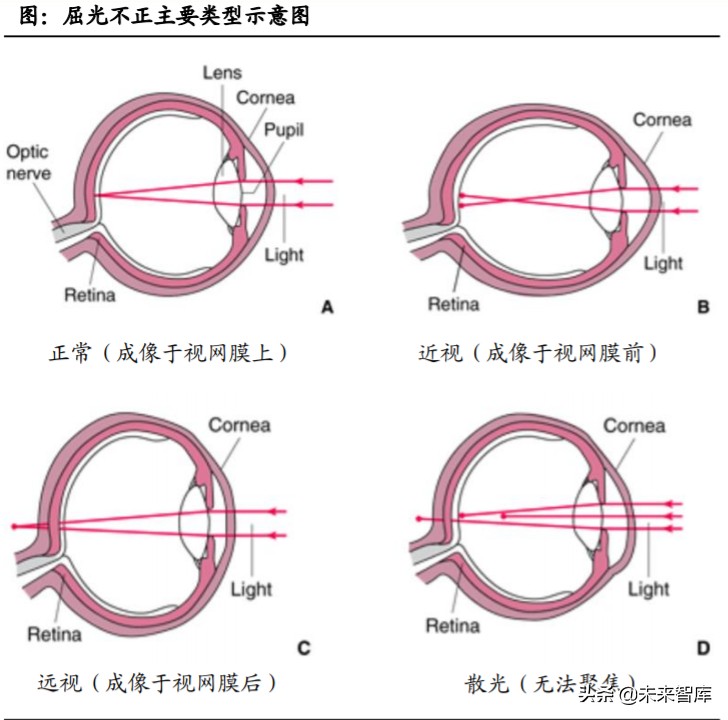 眼科產業鏈深度報告：創新驅動，服務為王