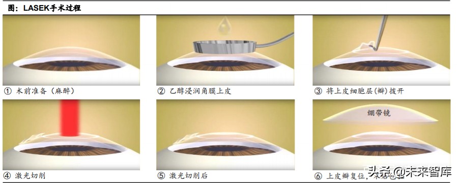 眼科產業鏈深度報告：創新驅動，服務為王
