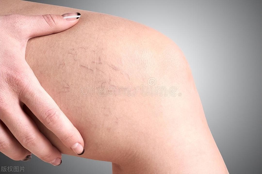 Itchy legs A sign of varicose veins? These symptoms require attention