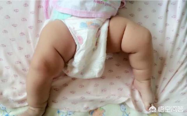 青蛙婴儿:宝宝“青蛙腿”，大人需要纠正吗