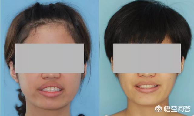 头条问答 做过牙齿矫正的同学们 你们的脸型变了吗 梦魇斯的回答 0赞