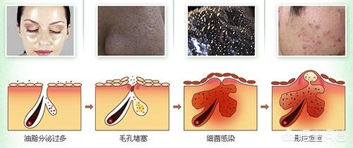 毛囊虫的原因是什么:毛孔里有白色条状物，是什么东西？