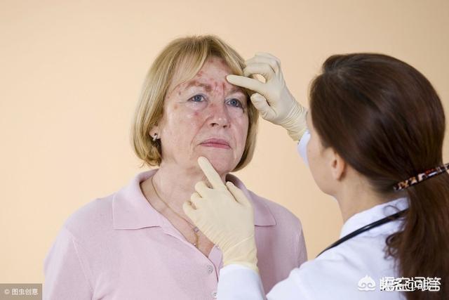 药物疹的症状图片靶向药在用药后出现了皮疹问题肺癌患者该如何应对