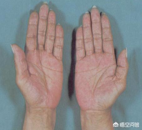 急性黄疸型肝炎根治吗:急性黄疸型肝炎会传染家人吗 什么是急性乙肝？有何表现？