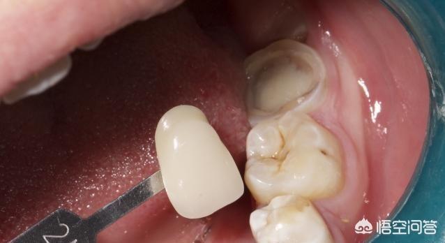 根管治疗后牙疼(根管治疗后牙齿的寿命)