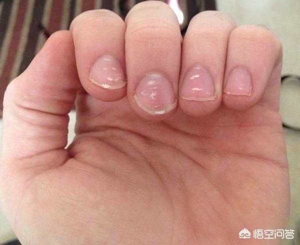 头条问答 - 宝宝手指盖发白是什么症状?(20个回答)