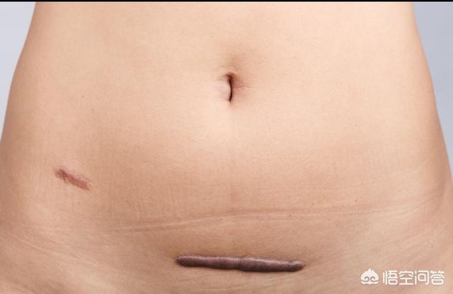 头条问答 剖腹产手术后 如何使伤口较快恢复 79个回答