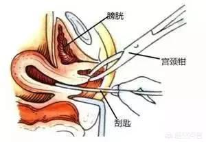 人流后，肚子疼而且月经不调是怎么回事？