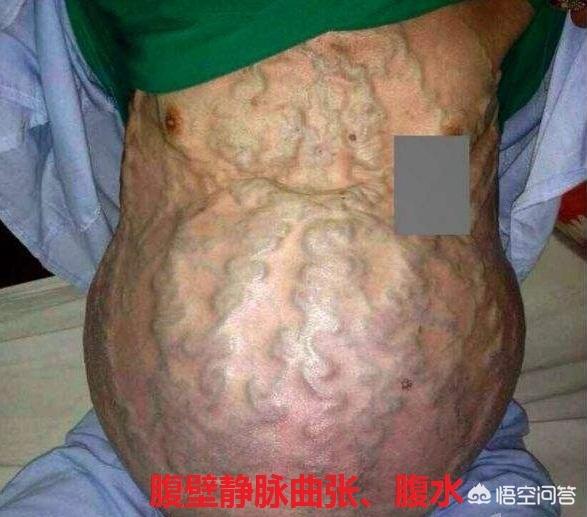 头条问答 - 肝硬化到失代偿期有什么不良反应?(11个回答)