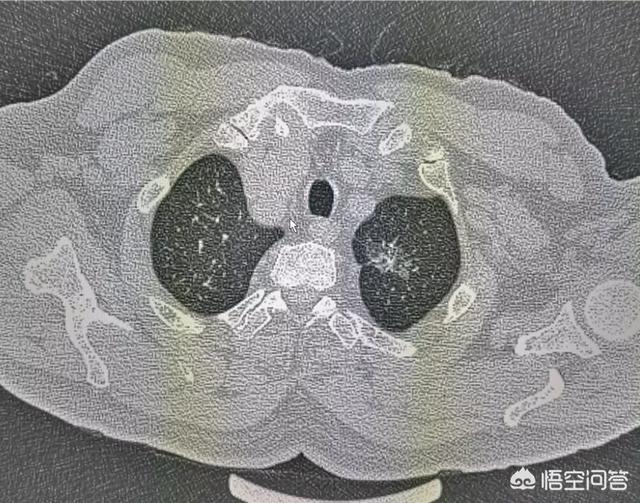 不影响寿命的十大癌症:癌症的最后结果都是死亡吗？有哪些注意事项？