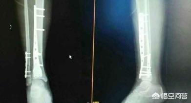 头条问答 胫腓骨骨折手术后多久取钢板 骨科木匠刘医生的回答 0赞