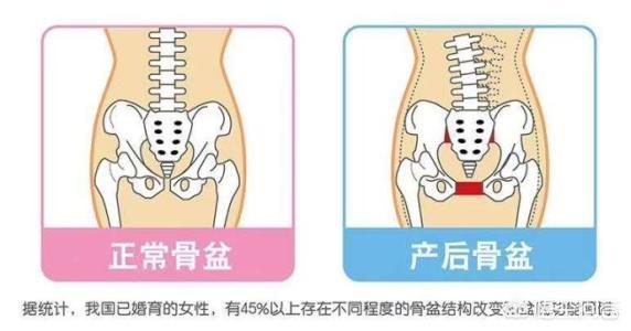 骨盆修复有必要吗,剖腹产有必要做骨盆修复吗？