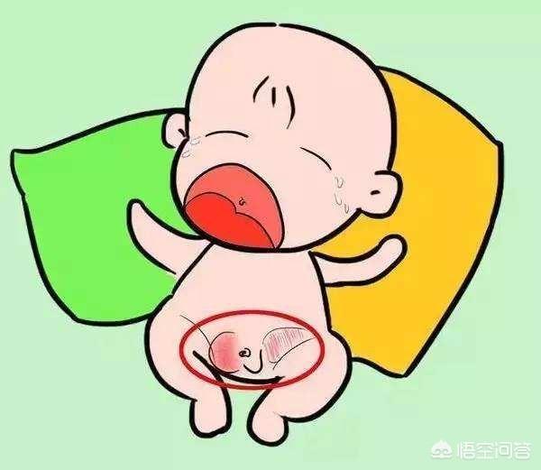 脐疝带:宝宝得了脐疝，需不需要治疗呢？怎样调理好宝宝的身体？