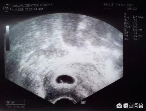头条问答 怀孕两个月 检查没有胎心胎芽 只有个空壤 这是什么情况 51个回答