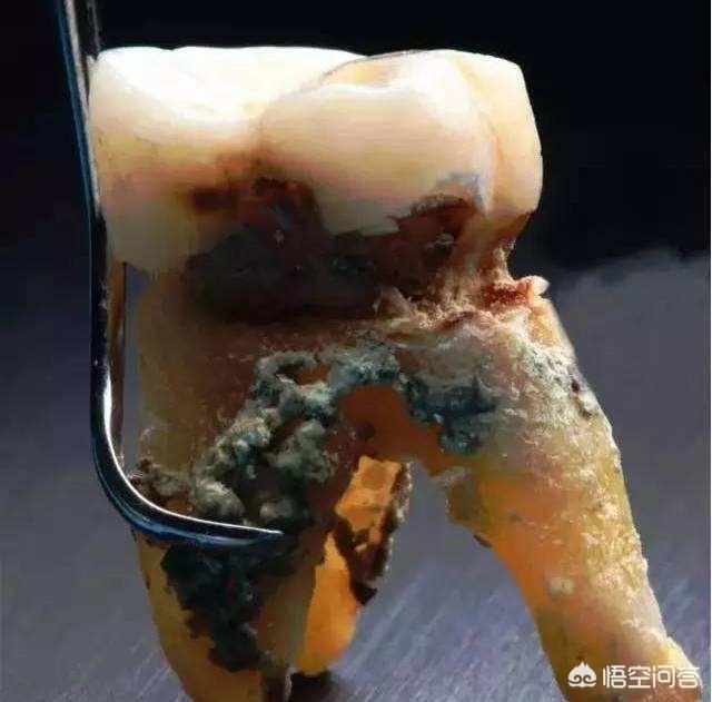 下牙掉了代表什么意思自己的下牙大部分都松动了这是怎么回事