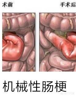 海龟肠梗塞的治疗:除了手术还有其他治疗肠梗阻的办法吗？ 肠梗塞一般要治疗多少钱