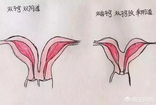 双子宫是怎么回事(双子宫是怎么回事影响生育吗)
