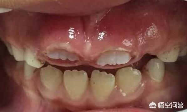 七岁半孩子门牙在牙龈中半年,一直长不出来是怎么回事?-育儿网