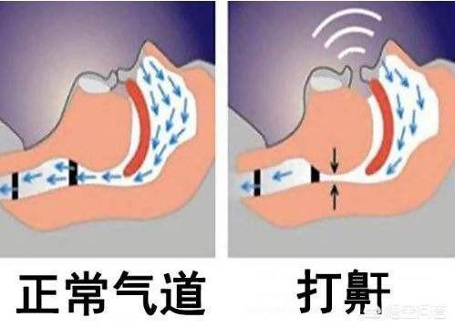 晚上睡觉打鼾怎么办：晚上睡觉打鼾有什么办法可以解决