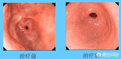 符晓薇:从胃炎到胃癌，仅仅只有4步，应该如何护胃