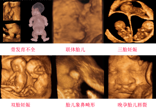 法乐四联症 误诊概率:法乐四联症主要病理改变 四维产检在多少周时去做最好？