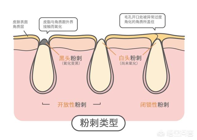 毛囊虫的原因是什么:毛孔里有白色条状物，是什么东西？