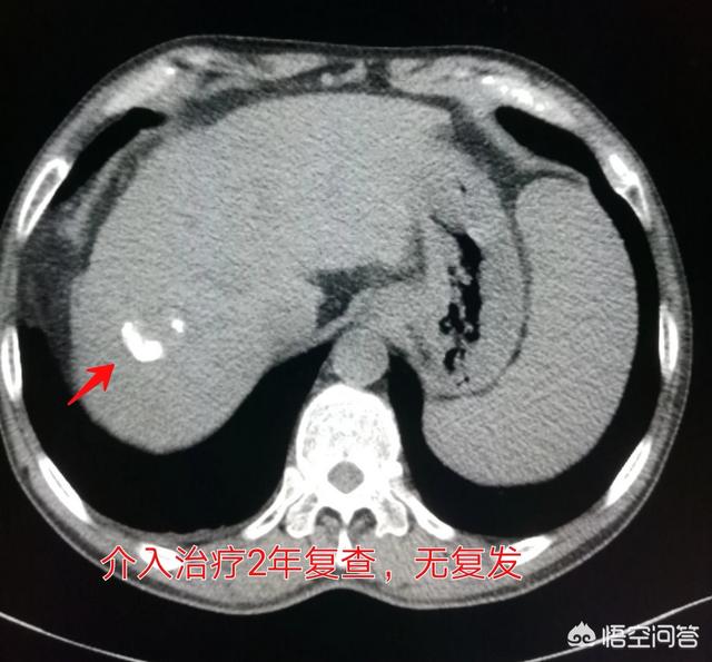 仑伐替尼最新价格,现在的医学技术可以治好肝癌吗？