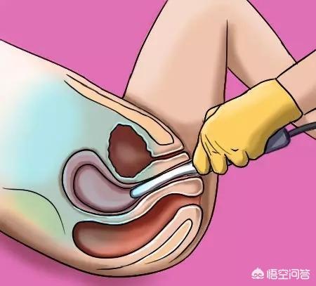 人流手术后注意事项:人流手术后注意事项和禁忌症 老婆刚做完流产手术，有哪些需要注意的地方？