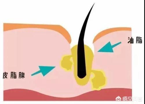 什么方法去黑头比较有效果，1、	你觉得真正有效的去黑头方法有哪些