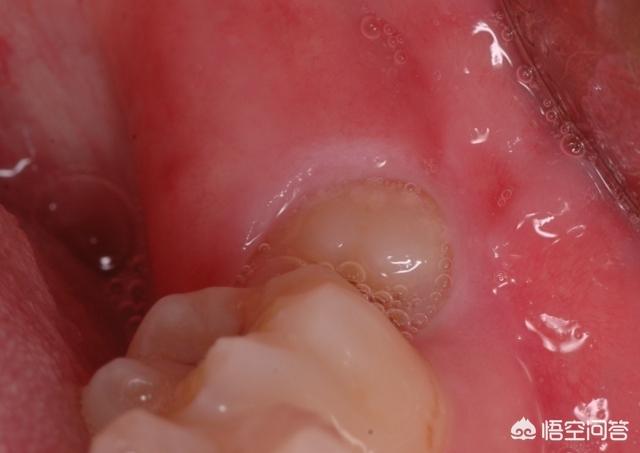 头条问答 牙龈发炎能不能拔智齿 8个回答