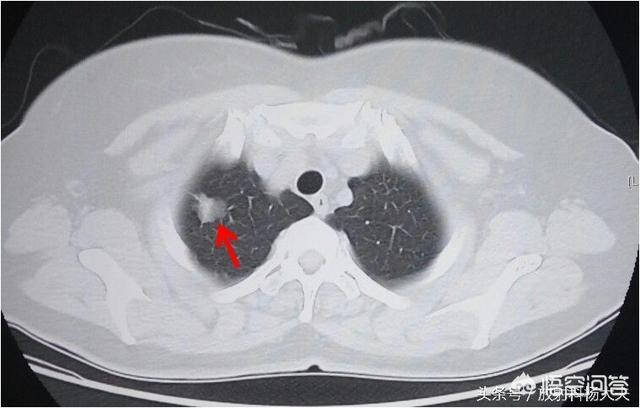 头条问答 - 胸片,胸透能早期筛查肺癌吗?(17个回答)