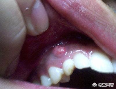 梦见牙龈上长花,牙龈上面长个包,怎么回事?