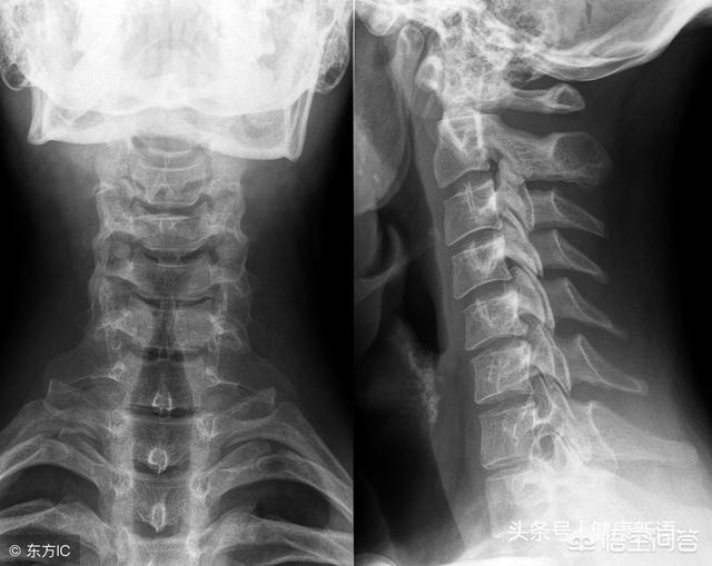 颈神经根炎的症状与治疗:颈椎病引起的头晕无力应该怎么治疗？