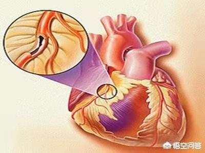 得了冠心病能出去旅游吗？插图32
