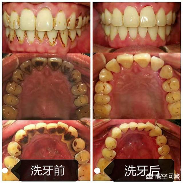 洗牙=美白牙齿吗？