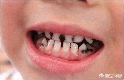 怎么预防龋齿的发生，生活中如何正确清洁牙齿，预防蛀牙，预防牙周炎
