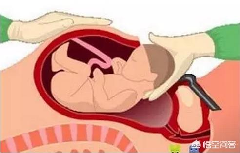 二胎跟三胎剖宫产有啥区别，二胎剖宫产跟三胎剖宫产有什么区别？