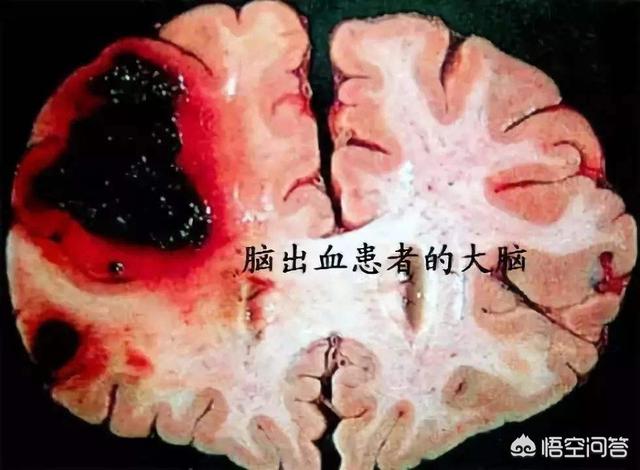 头条问答 - 血脂血压体重都正常,为什么也会出现脑出血?