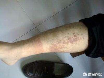 狂犬与蛮娇17-22:什么是紫癜，紫癜的病因是什么？ 狂犬与蛮娇30